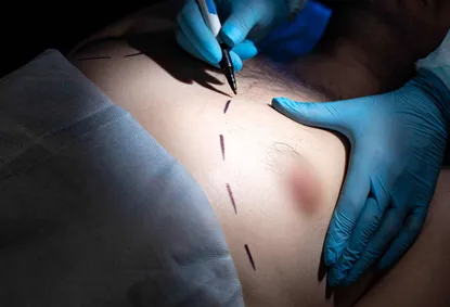 Gyno Surgery Cost in India: Procedure, Types & Best Hospitals Near You